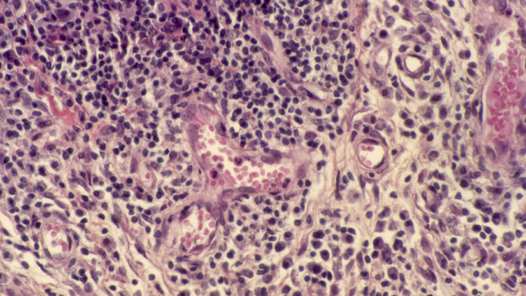 Artiva shuts autoimmune cell therapy trial after two patient deaths